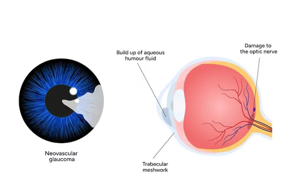 Glaucoma