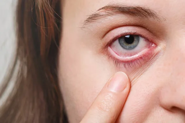 Dry Eye Treatment